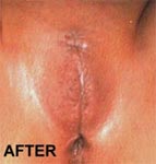 Female genital mutilation. 
